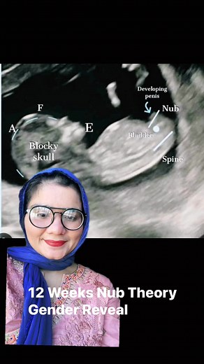 12 weeks nub theory gender reveal ultrasound scan | Dr.aneela manzoor-RPH