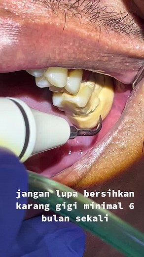 Pembersihan Karang Gigi: Tips Scaling Gigi dan Perawatan Terparah