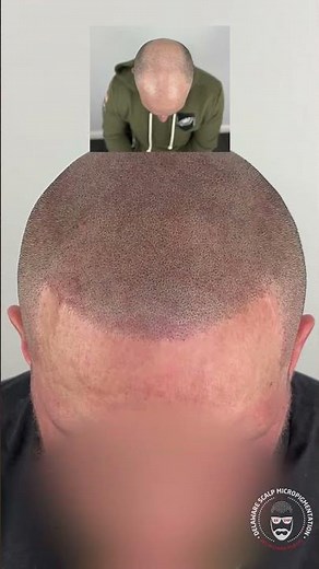 Scalp Micropigmentation Before and After | Bald to Full Hairline Transformation