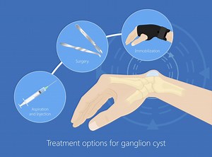Ganglion Cyst | Arizona Center for Hand to Shoulder Surgery