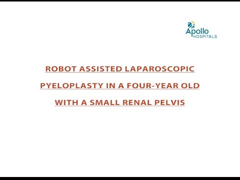 Robot Assisted Laparoscopic Pyeloplasty performed at Apollo Children's Hospital, Chennai.