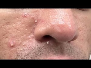 HOW TO GET RID OF WHITEHEADS QUICK AND EASY