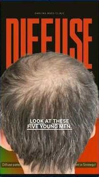 Hair transplant for Diffuse pattern alopecia