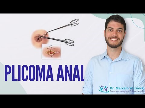 Anal plicoma. What is it? How to treat it?
