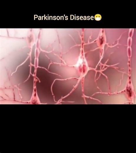 subscribe✌️#parkinson #disease #nursing #explorepage #mbbs #explanation #shorts #vlog #daily #viral