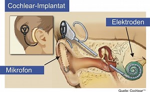 Cochlear Implants