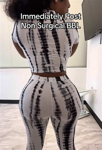 Baby the dolls are out here representing Luxe Dolls..!! 90 min transformation! #baltimorebodycontouring #bodycontouring #bodysculpting