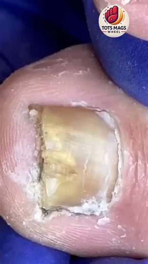 3.3K views · 22 reactions | Help for Discolored Nails in Daily Life, Clear Steps #FootCareTips #EverydayCare #HealthyHabits | Tots Mags Wheel | Facebook