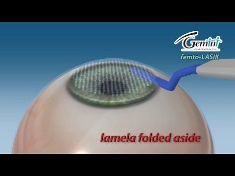 Femtosecond laser lasik animation