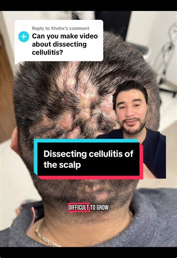 Dissecting Celullitis of the Scalp: Symptoms & Treatments