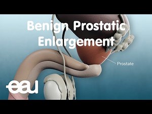 Benign Prostatic Enlargement (BPE)