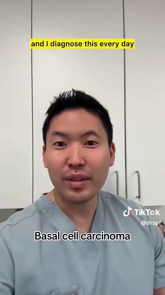 Basal cell carcinoma is the most common skin cancer—and it doesn’t always look obvious. Especially in skin of color, it can be subtle. What I tell my patients: 👉Any spot that’s changing month to month → get it checked 👉Any “pimple” or growth that won’t heal in 4 weeks → don’t ignore it Catching it early makes all the difference. #basalcellcarcinoma #skincancer #skincancerawareness #skinofcolor #drsugaiskincare