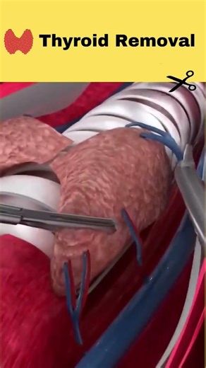 Goiter Explained in Urdu | Modern Treatment Options