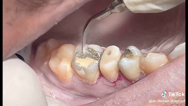 Scaling heavy calculus & tartar from teeth #dentist #dental #dentistry | teeth scaling