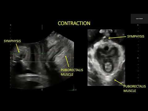 3-4D transperineal ultrasound