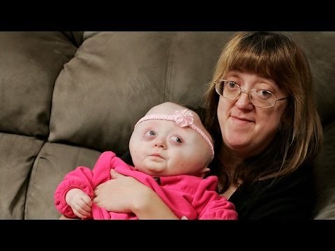 Crouzon Triplets: Body Bizarre Episode 4