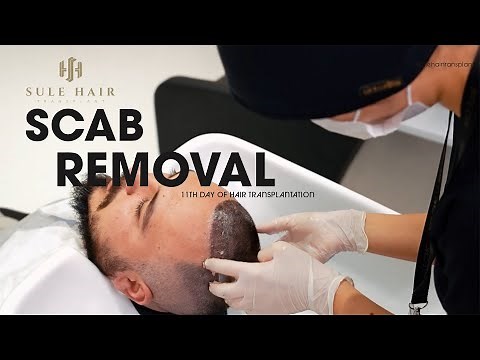 Perfecting Scab Removal on Day 11: Post-Hair Transplant Guide by Sule Hair Clinic