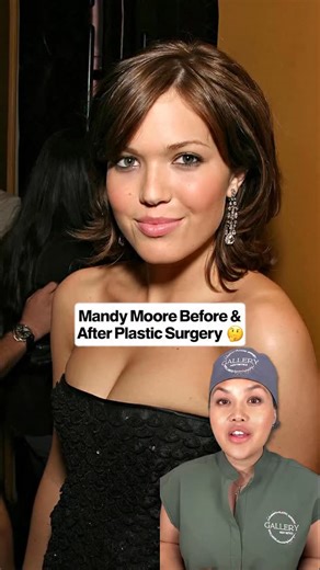 Mandy Moore before and after plastic surgery. #mandymoore #plasticsurgery #blepharoplasty | ladyplasticsurgeon