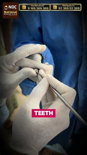 Silver vs Composite: Which Filling Is Better Today? || Best Dental Hospital || NDC