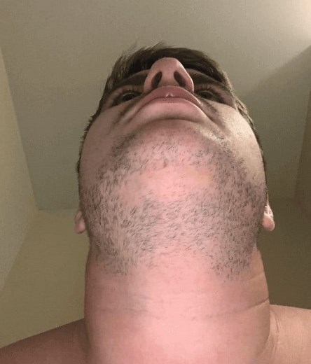 Beard Doesn’t Grow On Chin? Here's Why And How To Fix It!