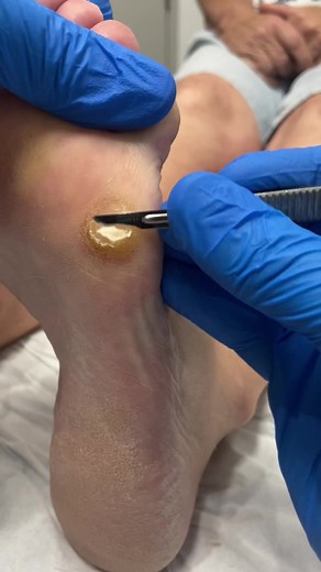 Effective Corn and Callus Removal by Expert Podiatrist