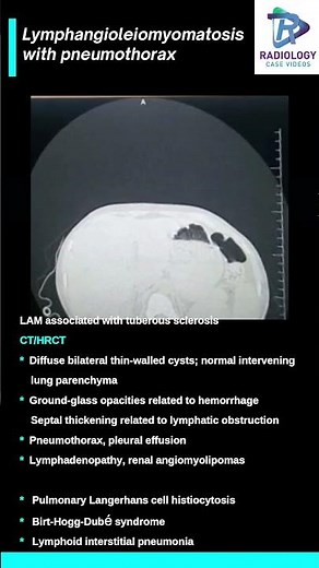 Lymphangioleiomyomatosis with pneumothorax