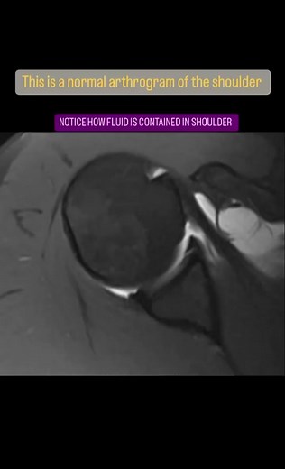 💢MRI review: SLAP lesion💢 Reading MRI’s can be so tough and it is definitely not something I learned in school But having this incredible team around me is what has helped me learn. Shout out to @dr_rajaram for the quick crash course on how to read this shoulder MRI 💪🙏 Big thing to note here is the absence of the anterior labrum in the second image when compared to the first. Also how the dye has leaked out of the shoulder capsule in the second image compared to the first 🫢 #otstudent #occu