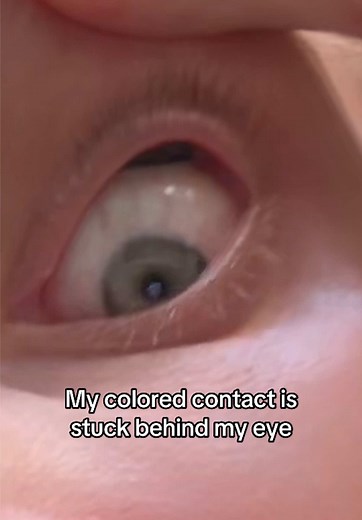My Colored Contact is Stuck Behind My Eye: Part 1