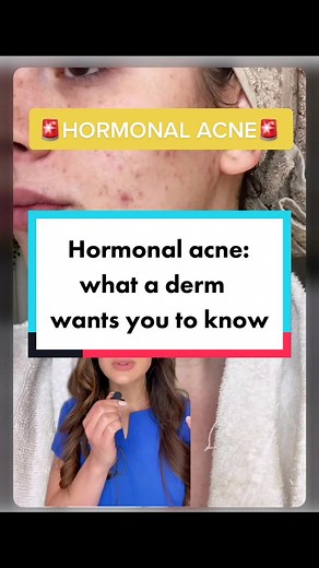 Understanding Hormonal Acne: Causes and Solutions