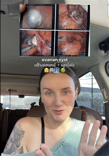 Welcome back to teratoma tok 🫣 #teratoma #ovariancyst #pmos #pcos #dermoidcyst