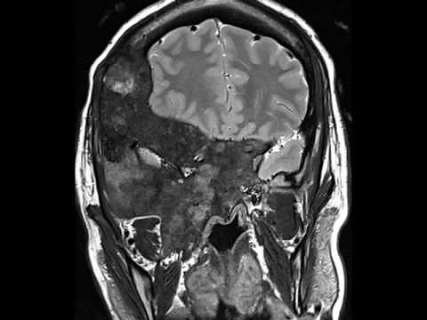 Fibrous Dysplasia MRI
