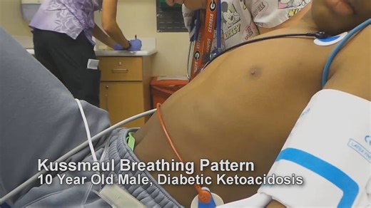29K views · 380 reactions | Kiểu thở Kussmaul là kiểu thở nhanh, sâu, đều. + Gặp trong: toan chuyển hoá nặng (biểu hiện đáp ứng hô hấp bù trừ) + Dễ bị nhầm là khó thở do nguyên nhân tim mạch hoặc phổi. | Hội Người Điều Dưỡng Trẻ | Facebook
