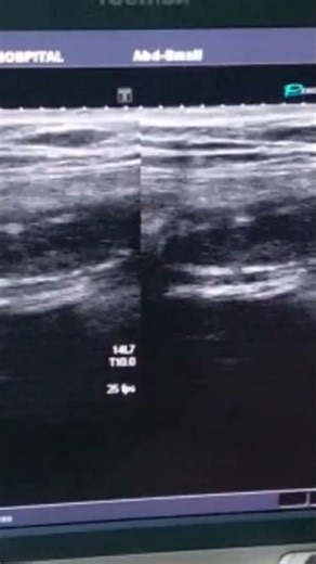 Appendicitis with fecalith #ultrasound
