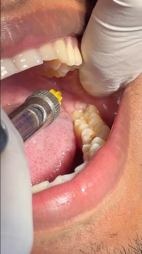 Local anesthesia #dental #dentist