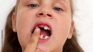 Little blond girl with blue eyes touching and showing milk tooth in toothless mouth on white isolated background. New tooth formation and milk baby tooth extraction. Need tooth crown and braces
