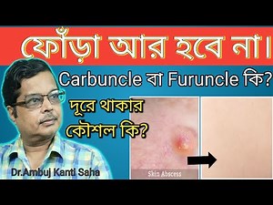 Skin Abscess, Causes, Signs and Symptoms, Diagnosis and Treatment | Homeopathy and home remedies