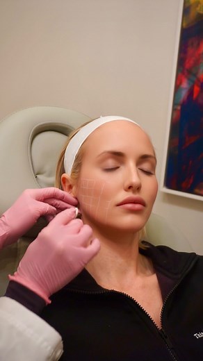 Revive your skin with #skinvive, your skins hydration savior!💧 ✨ As the first FDA-approved hyaluronic acid (HA) microdroplet injectable in the U.S., SkinVive offers a revolutionary approach to rejuvenating your complexion. Unlike traditional fillers, #SkinVive works at the epidermal layer, spreading hydration, stimulating collagen, and smoothing cheeks for a naturally radiant glow. Say hello to rosy, hydrated cheeks that last up to six months, with no downtime! 💟 #greenwichmedspa | Greenwich M