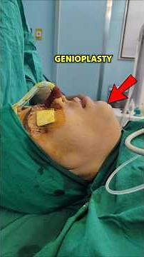 Minimal Incision Sliding Genioplasty Surgery | Faster Healing & Less Swelling