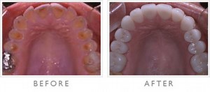 Types Of Eating Disorders