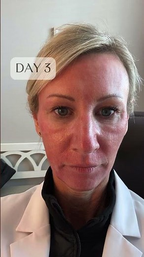 😱 The recovery behind a CO2 laser skin resurfacing! Don't worry, it's worth every day of recovery 😉