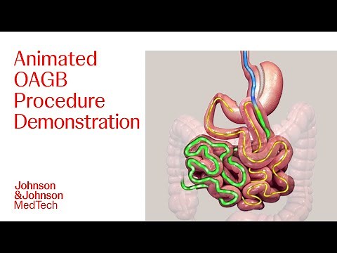 One Anastomosis Gastric Bypass (OAGB) Animated Patient Education Video | J&J MedTech