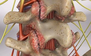 Osteoarthritis | Causes, Symptoms, and Treatments
