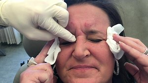 "Bunny lines" are wrinkles on the upper sides of the nose. Some people naturally have these lines while others develop them as a compensatory effect after having Botox to their frown lines. This can be easily corrected with Botox to the underlying muscle causing these lines. -with Matt Kelleher, MD #botox #wrinkles | Premier Dermatology | Facebook