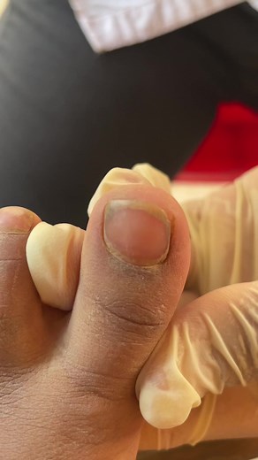 Pedicure #fypシ #fyp #foryou #ingrowntoenail #nails