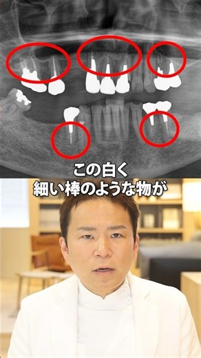 根管治療のあとが目立つお口には歯周病の魔の手が迫っていました