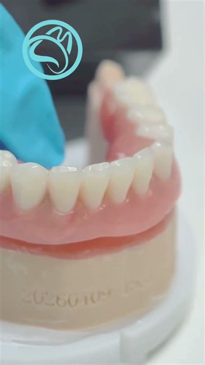 Implant‑Supported Overdenture with Locator Attachments for Dr Abjacket #dentallab #dentist