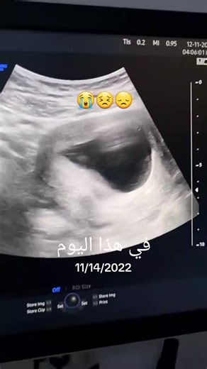 علاج العقم وتجاوز الصعوبات في الحمل بعد سبع سنوات