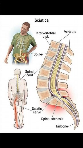 Flip Test of the Back | Quick Orthopedic Exam Explained #backpain #chiropractor #physiotherapy