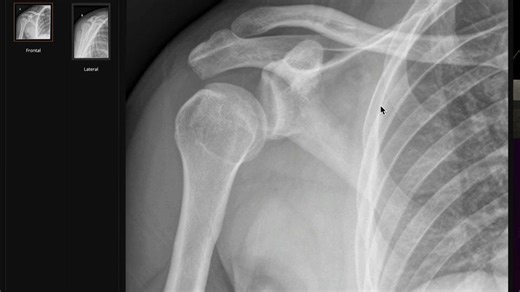 6、肩关节后脱位影像教学〖Radiology Channel〗双语精校