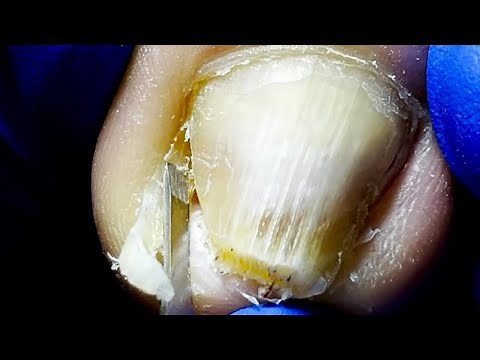 Pedicure Tutorial Take Care Of Your Toenails And Stay Away From Ingrown Nails